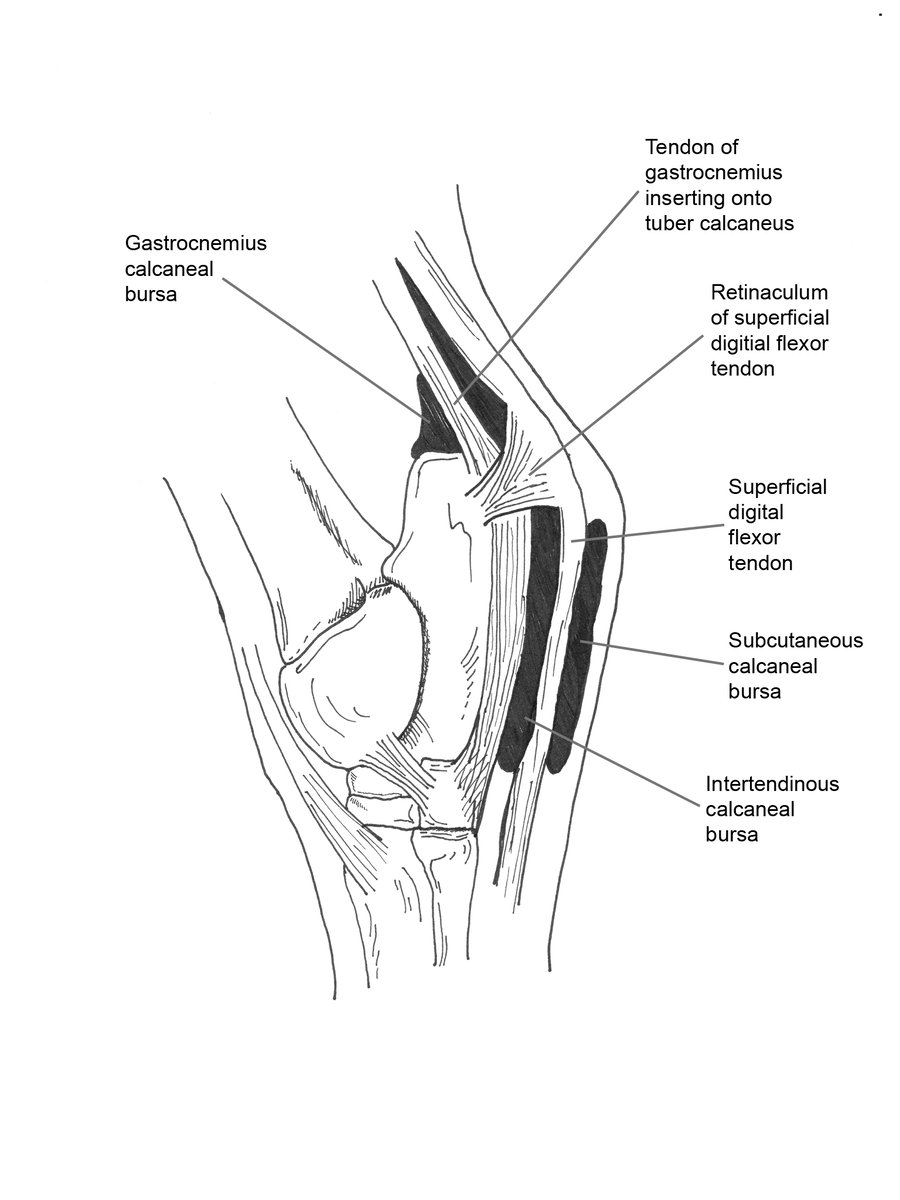 Technique Tuesday - Injection of the Calcaneal Bursa